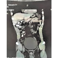 X光顯示，龍男體內塞滿「毒香腸」。