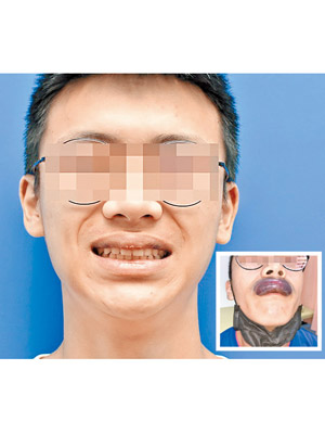 男事主上唇嚴重腫脹（右圖），開刀後恢復正常（圖）。（互聯網圖片）