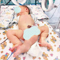 男嬰擁有比常人多的器官。