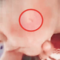 幼童臉部紅腫。
