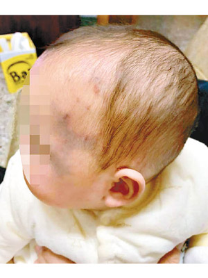 孩子的額頭出現大片瘀青和紅腫。