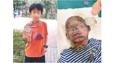 尹姓男童因家中起火被嚴重燒傷。