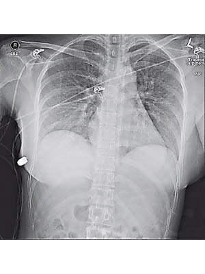 X光照片顯示子彈卡在女子右胸。