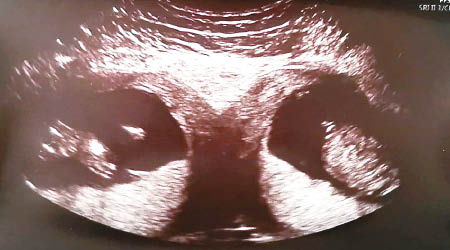 超聲波照可見雙子宮各有胎兒。