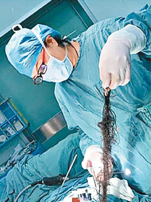 醫生在畸胎瘤中取出毛髮。