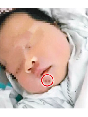 女嬰下巴留下多個齒印坑洞（紅圈示）。