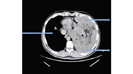 掃描顯示，患者部分小腸進入左胸腔。