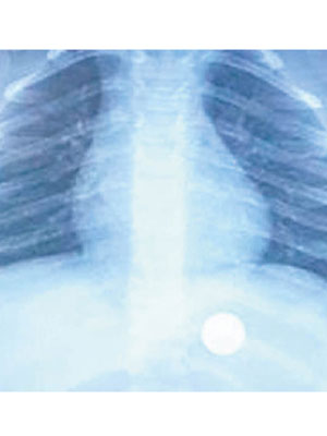 X光片可見，硬幣落在斯科特兒子的胃中。