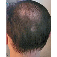 左圖：有實驗者年輕時開始甩頭髮。右圖：經植菌後新長出的頭髮完整覆蓋頭頂。