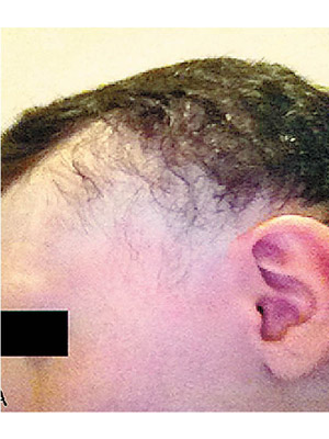 左圖：有實驗者年輕時開始甩頭髮。右圖：經植菌後新長出的頭髮完整覆蓋頭頂。