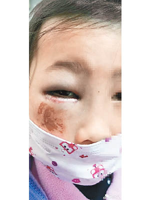 女童眼睛受傷險致失明。