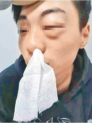 李男的鼻骨骨折。