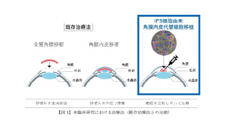 新療法手術示意圖。