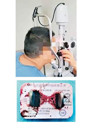 充電器爆炸後（下圖），陳先生趕至眼科中心求醫。