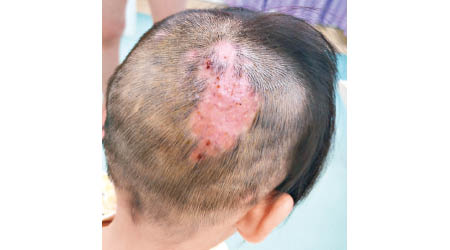 動物真菌感染髮囊，女童出現局部脫髮。
