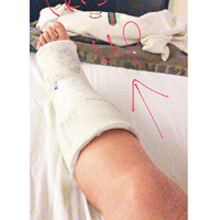 手術後，欣宜的傷腳打上石膏。