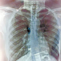 張秀文照肺發現脊椎側彎，解埋周身痛之謎。