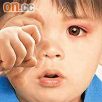 兒童揉眼睛是眼敏感徵狀之一。