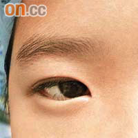 兒童眼敏感揉眼睛可使周邊眼皮變厚。
