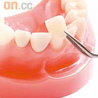 利用瓷貼美白牙齒，須先打磨牙齒，因此接受療程前應考慮清楚。
