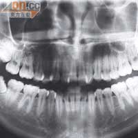 箍牙前醫生會替病人照X光等詳細檢查，了解牙齒情況。