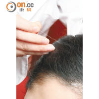 針灸可改善頭髮稀疏及脫落問題，令髮絲回復濃密。
