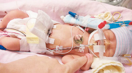 現年3歲3個月的諾呈是在33周出世的早產兒，出生時只有1.475公斤，並出現呼吸及消化系統問題。