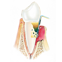 每次牙肉發炎都會令骨膜收縮，形成更大隙縫，當它積聚了細菌和污垢，又會再度引發痛症。