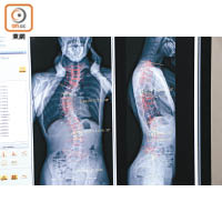醫療團隊可根據EOS檢測得出的結果，判斷病人的脊柱側彎情況。