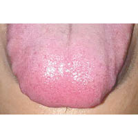 脷苔厚或舌頭有齒印是體內濕氣重的表現。