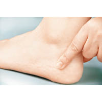 手指按實腳跟，皮膚如需長時間才回彈，有機會是水腫。