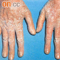 過度洗手可導致脫皮、起泡、敏感，甚至發炎潰爛。	（圖片由黎湛暉提供）
