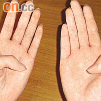 以雙手作比較，左手拇指的屈曲度明顯不及右手拇指。