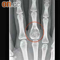 一名女性患者在打球時骨折，始發現右手中指有內生軟骨瘤（紅圈示）。