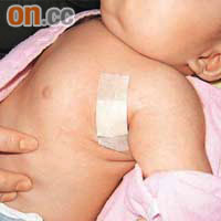 初生嬰出生一至兩日後會接受注射卡介苗。