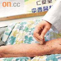 病人郭先生接受四個多月針灸治療後，手腳明顯較靈活。	（鍾麗珊攝）