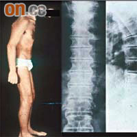 強直性脊椎炎患者的脊椎會因自身免疫失調而長期發炎，骨與骨之間連成竹竿狀，如圖中所示，右圖為正常脊骨。