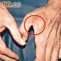 左手虎口位（圓圈示）萎縮，顯示肘隧道症候群嚴重惡化。