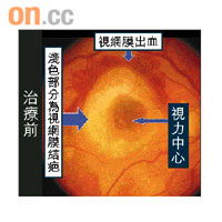 沒接受治療的患者視網膜會出現結疤及出血，覆蓋視力中心令患者不能正常視物。