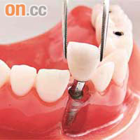 除訂製一副假牙外，市民仍可選擇植牙技術。