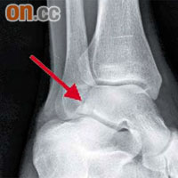 愈來愈多人玩雪板時不慎導致腳踭外側骨折，稱為「雪板足踝」。