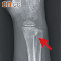 手腕骨折不但要打石膏，更可能要做手術處理骨骼移位。
