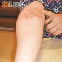 濕疹病患者皮膚會痕癢、紅腫、乾燥、脫皮及發炎。	（資料圖片）