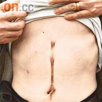 阿樂展示五年前切除胃部癌細胞組織而留下的疤痕。