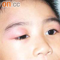 李先生之子由眼瞼至雙腳均遭蚊子叮至嚴重紅腫。