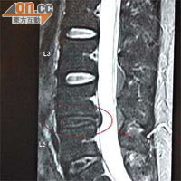 磁力共振影像顯示陳先生最尾兩節椎間盤呈暗黑色，即已出現退化，其中一節更已明顯凸出（紅圈示），是造成腰痛的根源。（受訪者提供圖片）
