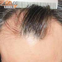 髮線向後移、頭髮稀疏者應及早治療。