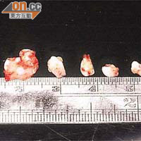 醫生於男童上顎找到六粒牙瘤，最大一粒約九毫米。