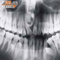 牙瘤一般出現在上顎門牙附近，可以完全阻擋恒齒的生長路徑。（受訪者提供）
