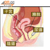 左圖：骨盆底韌帶鬆弛可致子宮下垂，嚴重者子宮會經陰道凸出體外。右圖為正常情況。	（受訪者提供）